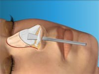 Operazione Di Rinoplastica: Virtual Nose Job Surgery